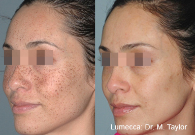 before-after